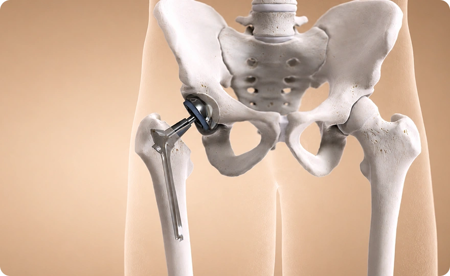 Hip replacement implant model for hip replacement surgery in Chennai